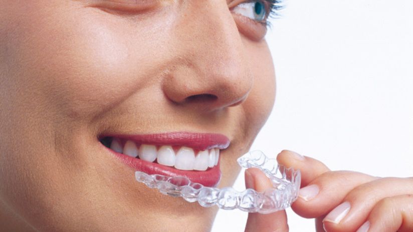 woman putting in Invisalign