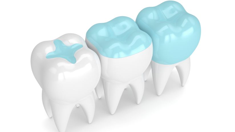 cartoon image of dental fillings