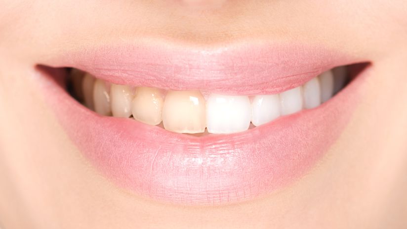 Before and after teeth whitening at Woodcroft